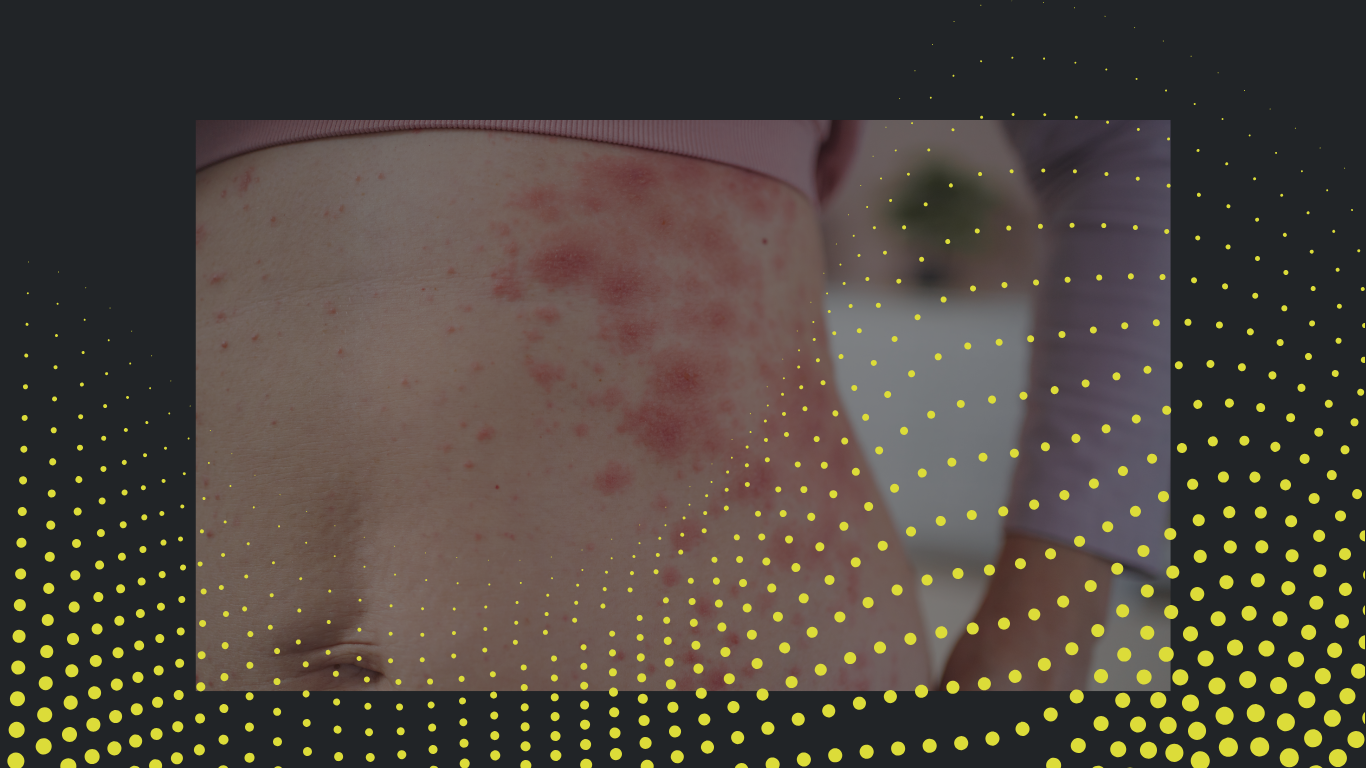 12 anaphylaxis awareness.png